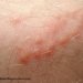 How to protect yourself from flea bites